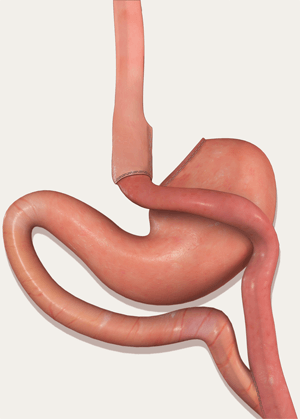 Gastric Sleeve