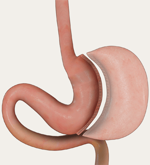 Gastric Sleeve